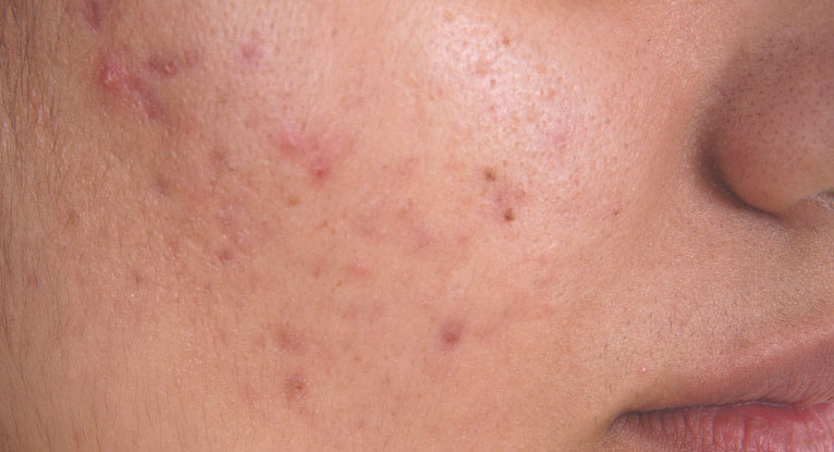 Axit salicylic so với Benzoyl Peroxide1