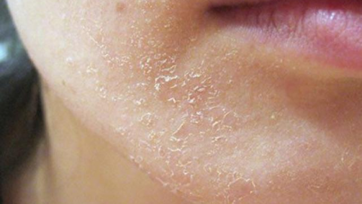 Benzoyl Peroxide3