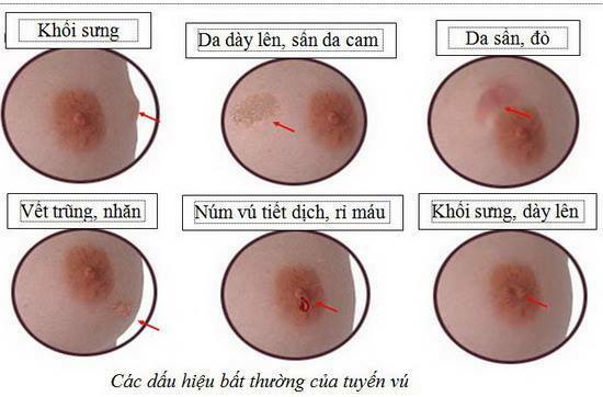 Các biểu hiện của ung thư vú