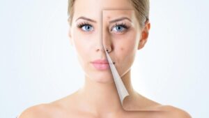 điều trị mụn không cần kê đơn
