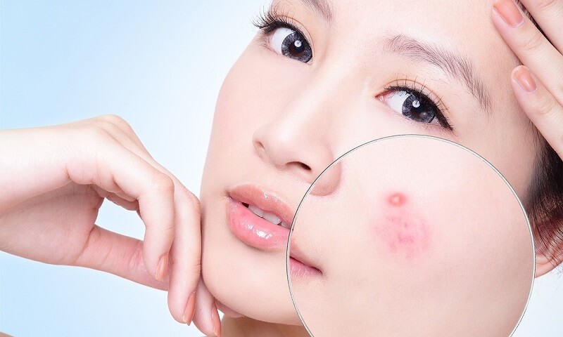 mụn đầu trắng 2