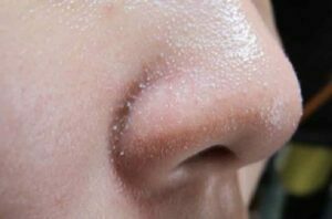 mụn đầu trắng