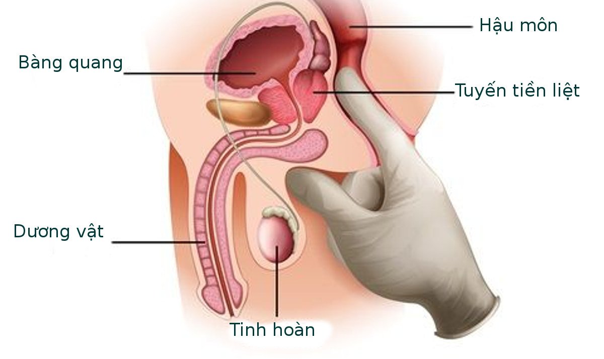Bệnh ung thư tiền liệt tuyến