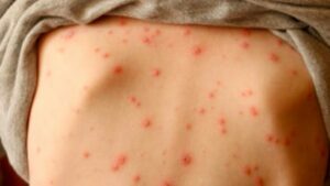 viêm da ảnh đại diện