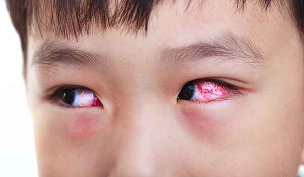 đau mắt đỏ