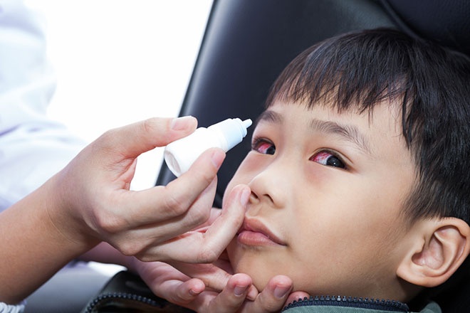 đau mắt đỏ2