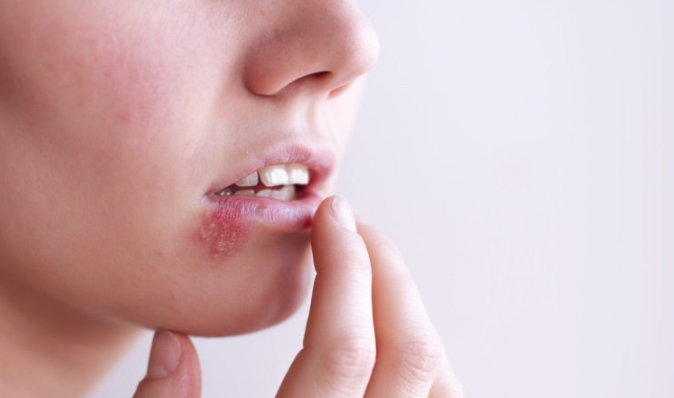herpes