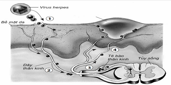 herpes1