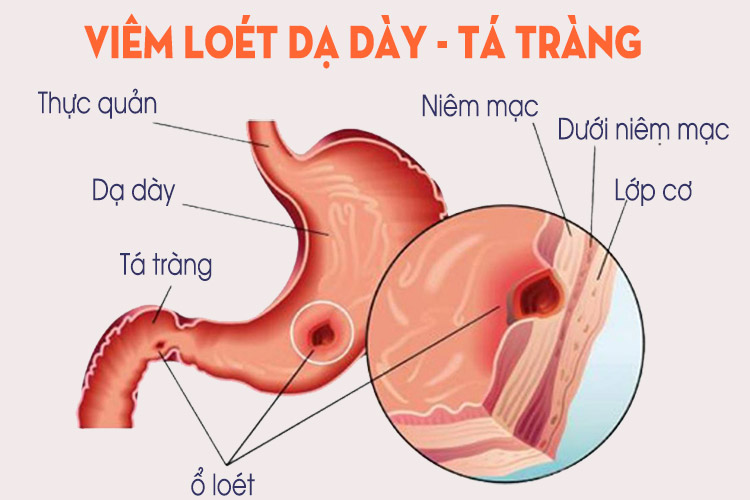 loét dạ dày