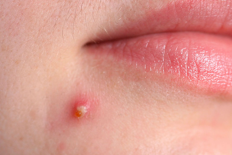 mụn bọc mủ