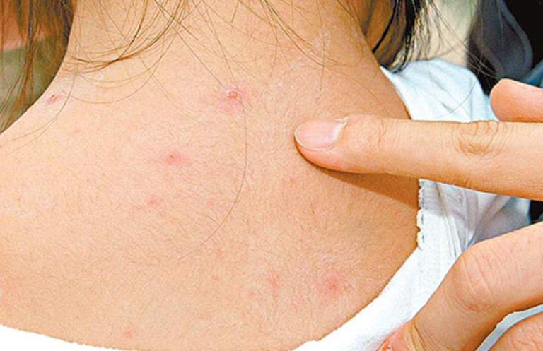 thủy đậu1