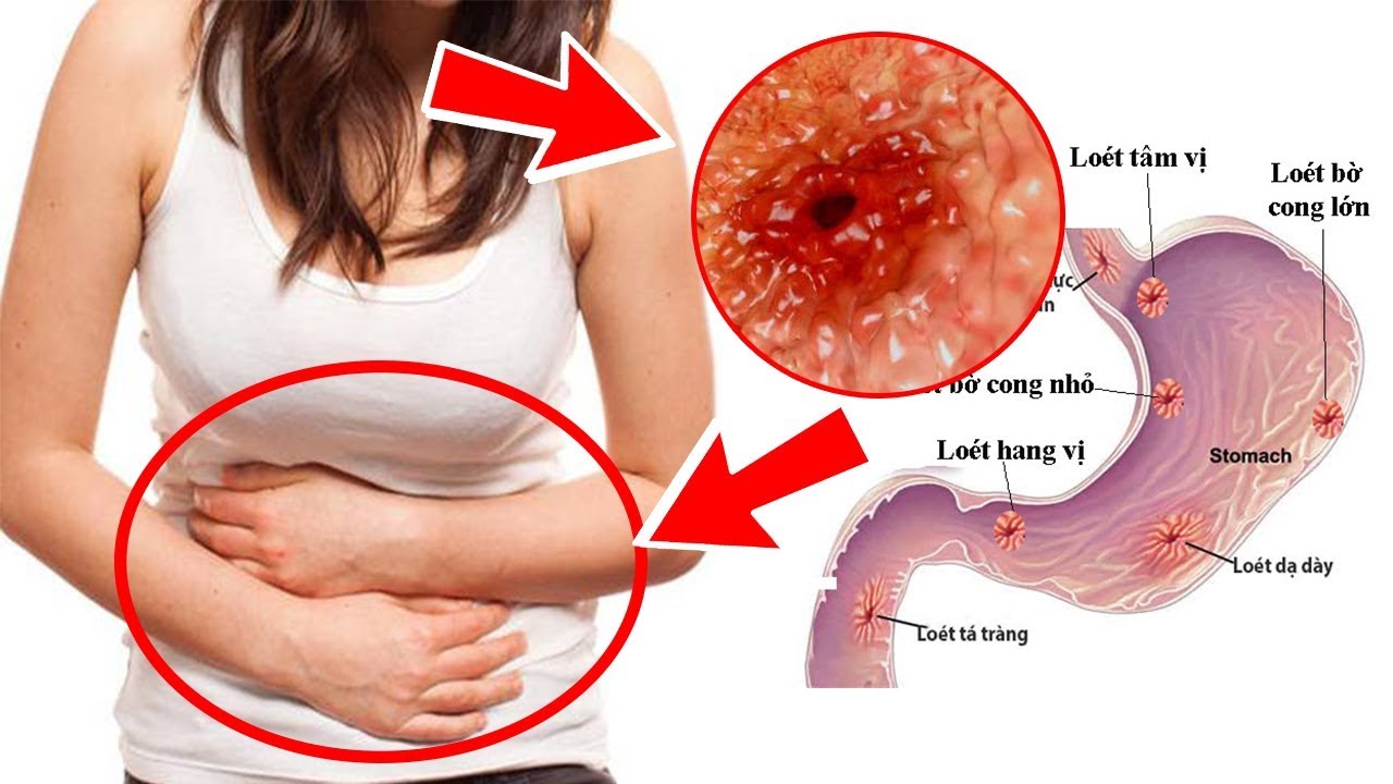 viêm loét dạ dày