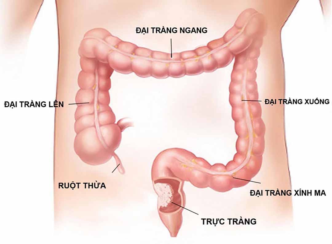 viêm loét đại tràng