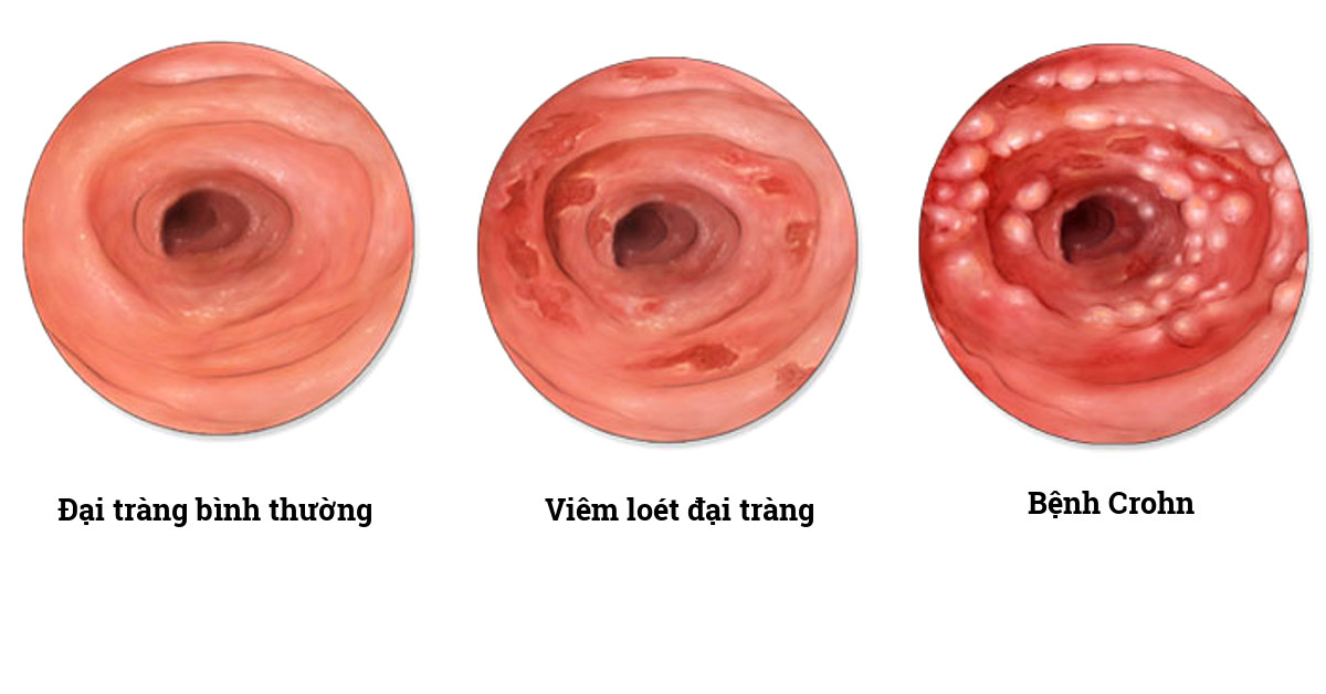 viêm loét đại tràng3