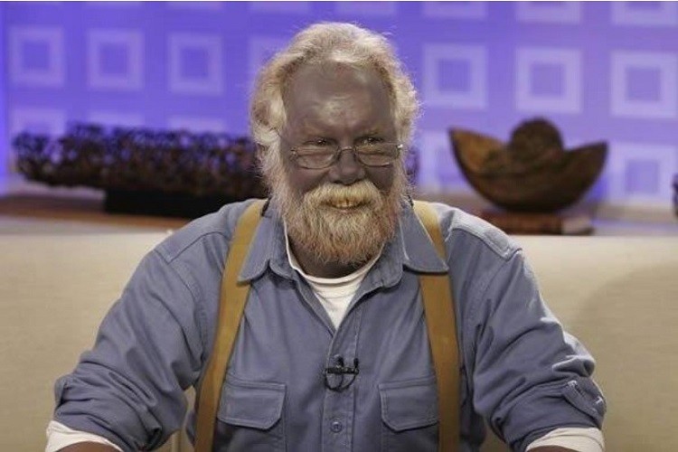 Argyria