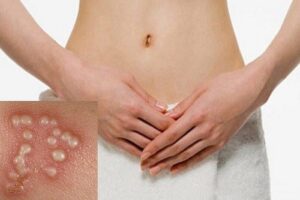 Bệnh Herpes sinh dục