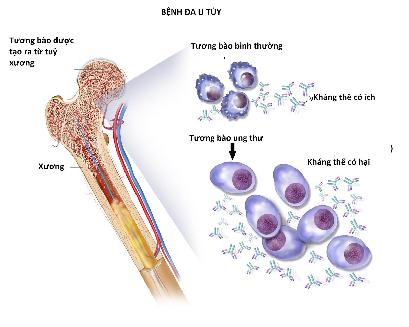 Đa u tủy (thuộc loại ung thư máu dòng tủy)
