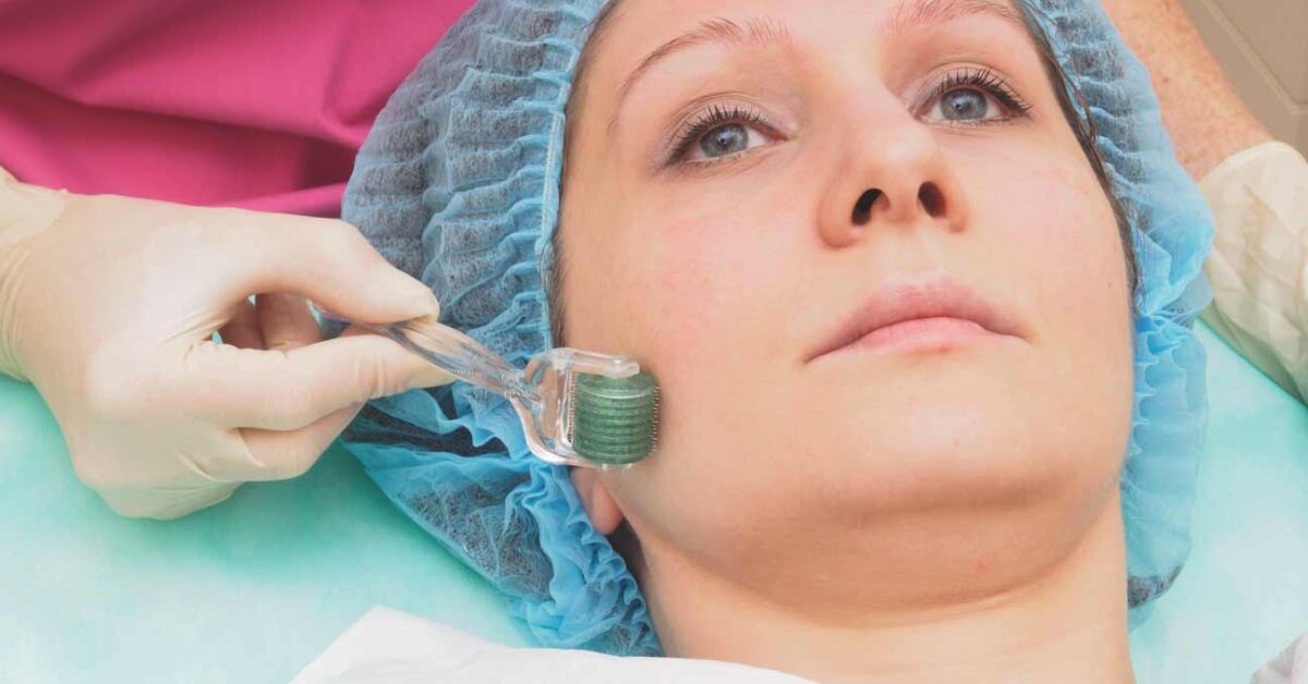 Microneedling