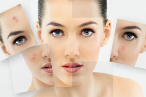Tác dụng của Tretinoin