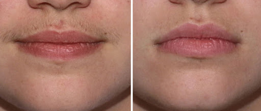 Tẩy lông, dùng thuốc không đúng cách