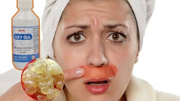 Tẩy lông mép bằng oxy già
