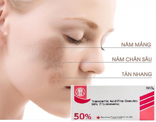 Tranexamic Acid bôi da