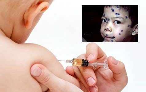 Vacxin thủy đậu