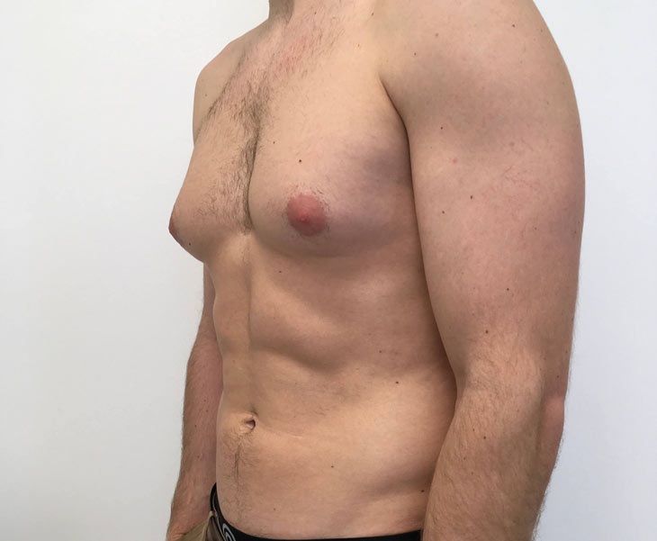 nồng độ estrogen cao gây Vú to