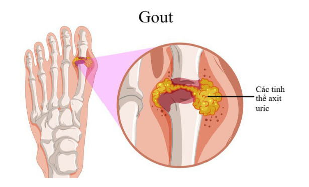 benh gout