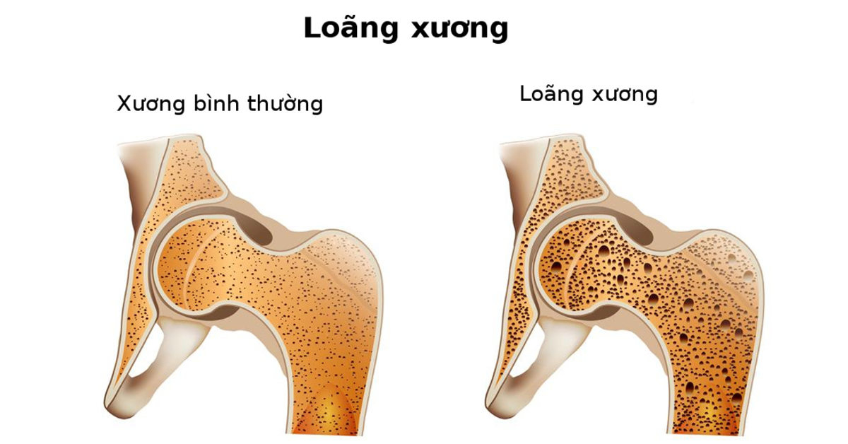 loãng xương