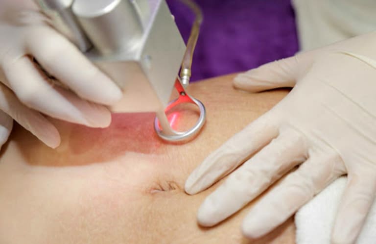 rạn laser