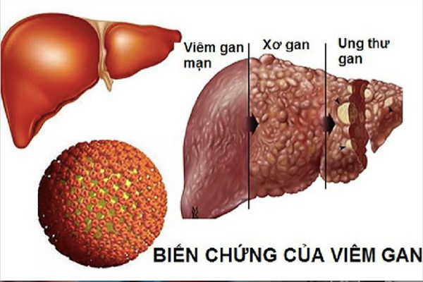 viêm gan b