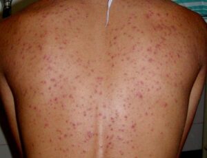 mụn lưng lắm vl