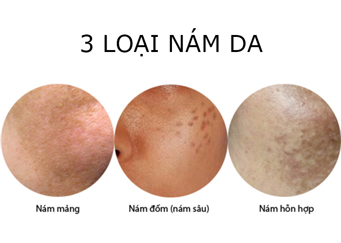 các loại nám da