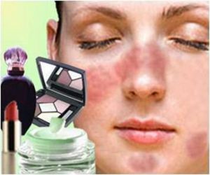 dị ứng mỹ phẩm