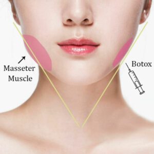 tiêm botox 2