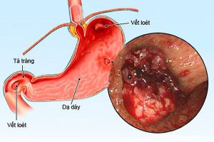 viêm loét dạ dày